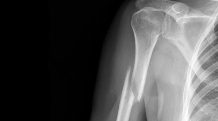 Фрактура на раменната кост: причини, видове и симптоми, първа помощ, лечение