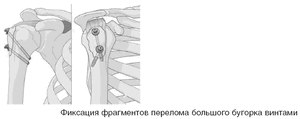 Фрактура на голямата туберкулоза на раменната кост: причини, симптоми и методи на лечение