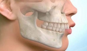 Фрактура на горната челюст: причини, видове, симптоми и методи на лечение