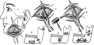 Фрактура на горната челюст: причини, видове, симптоми и методи на лечение
