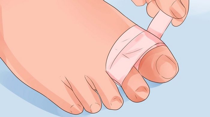 Счупвания на пръстите: какви са, как да разпознават и лекуват първа помощ