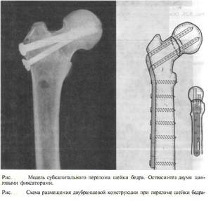 Остеосинтеза на бедрената кост: при какви условия се показват видовете, цената, прегледите, рехабилитацията