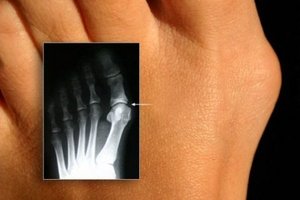 Отстраняване на костите на големия пръст: индикации за операция, видове и разходи, рецензии