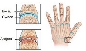 Палеца на ръката боли: за това какви травми и болести говорят такъв симптом