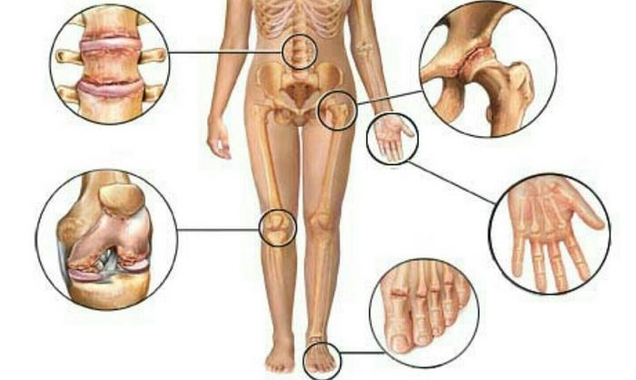 Туберкулоза на костите и ставите: форми, причини, признаци и методи на лечение