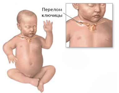 Как и защо се получава фрактура на ключицата при новородено по време на раждане?