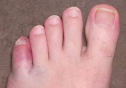 Пронизваща болка в малкия пръст на крака