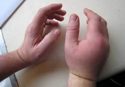 Как се лекува насинената ръка?