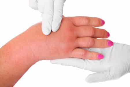 Симптоматология и лечение на нараняване на пръстите на ръката