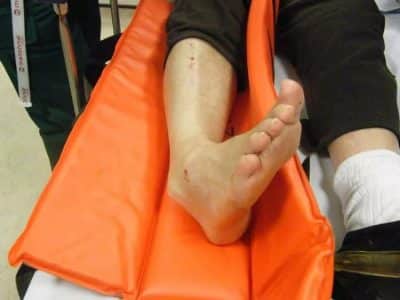 Травма на долните крайници: симптоми и лечение на разместване на крака