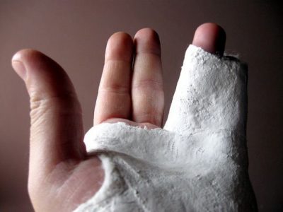 Лечение на фрактури на малкия пръст и други пръсти на ръката