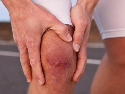Какво представлява натъртването на коляното?
