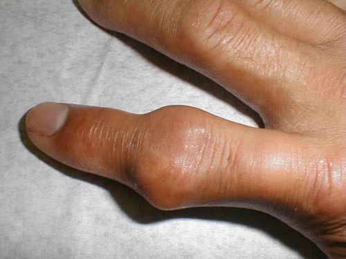 Ортези на пръсти на ръка
