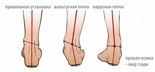Обувки с валгусова деформация на крака