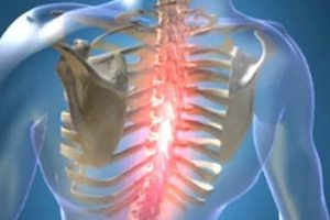 Остеохондроза на гръдната област и радикуларен синдром - симптоми, лечение