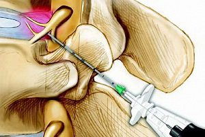 Блокада с херния на лумбалния гръбнак - ефективно лечение на силна болка
