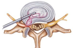 Консервативно лечение на херния на гръбначния стълб: сложно приложение на медицински техники