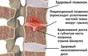 Hernia shmorlja на лумбалния отдел на гръбнака - нюанси на лечение
