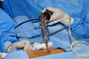 Как е хирургично отстраняване на херния лазер?