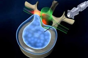 Лазерно отстраняване и лечение на херния на гръбначния стълб