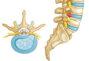 Операция за премахване на междузвездната херния в долната част на гърба: видове хирургия и методи за възстановяване