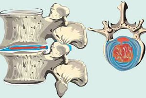 Прострукция в гръдния кош, признаци и лечение