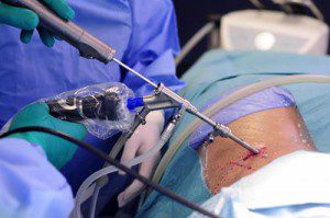 Премахване на херния интервертебрален диск - видове микрохирургични операции