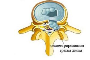 Последователна херния на гръбнака: симптоми и лечение