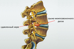 Симптомите, причините и лечението на гръдната херния