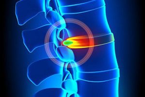 Ползи и увреждане на затягането с херния на гръбначния стълб