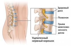 Лечение на междувертебрална херния по метода на д-р Бубновски