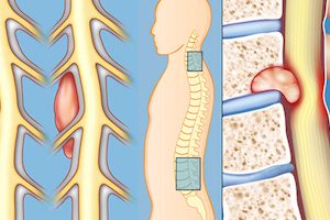 Рак или херния на гръбначния стълб - как да разберем?