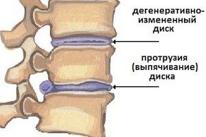 Движението на гръбнака спомага за изпъкналостта на диска