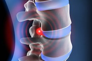 Дръснална херния на гръбнака: признаци и лечение