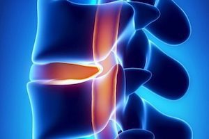 Дръснална херния на гръбнака: признаци и лечение