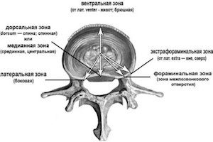 Екструзия - начален етап на херния на гръбнака