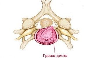 Характеристики на гръбначния стълб на херния