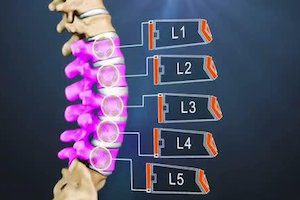 Хернизиран диск на лумбалния гръбнак: причини, симптоми, методи на лечение
