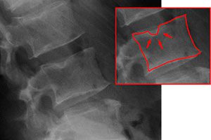 Многобройни хернии на гръбначния стълб - какво е това и как да се лекувате