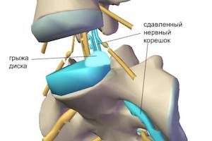 Признаци на лумбален гръбнак и признаци на лечение