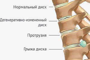 Статично сцепление с херния на гръбначния стълб - няма да повреди упражненията