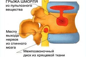 Курсът и лечението на херния на Schmorl в гръдния край на гърба