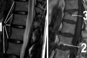 Курсът и лечението на херния на Schmorl в гръдния край на гърба