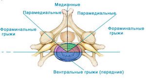 Видове ляво-едностранна херния на гръбнака