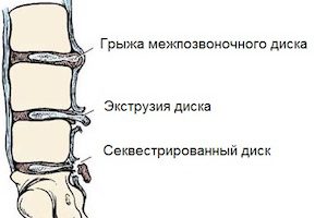 Видове херния на лумбалния гръбначен стълб и признаци на тяхното лечение