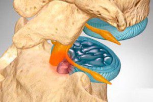 Видове херния на лумбалния гръбначен стълб и признаци на тяхното лечение