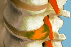 Защо се появява дискова херния на гръбначния стълб и как се лекува?