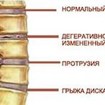 Апликатор kuznetsova от херния на гръбначния стълб