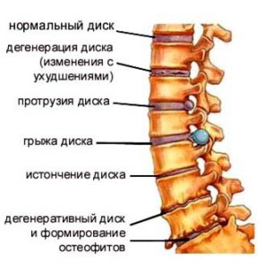Карипазим с инструкция за херния на гръбначния стълб