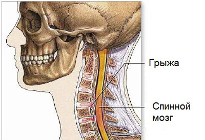 Херния върху симптомите на шийния гръбначен стълб